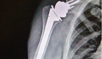 La patologia artrosica della spalla ed il trattamento chirurgico di protesi inversa